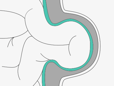 A drawn graphic of a hernia