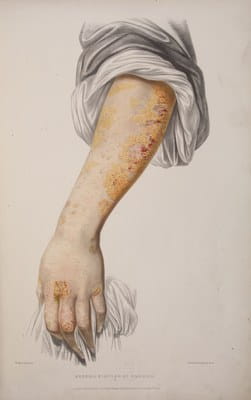 Erasmus Wilson, Portraits of Diseases of the Skin 1855
