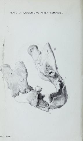 Phossy Jaw 2: Cornelia's jawbone