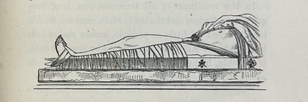 Drawing showing a man with a splinted and bandaged leg.